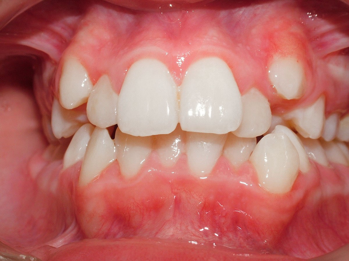 شلوغی دندان یا کراودینگ دندان