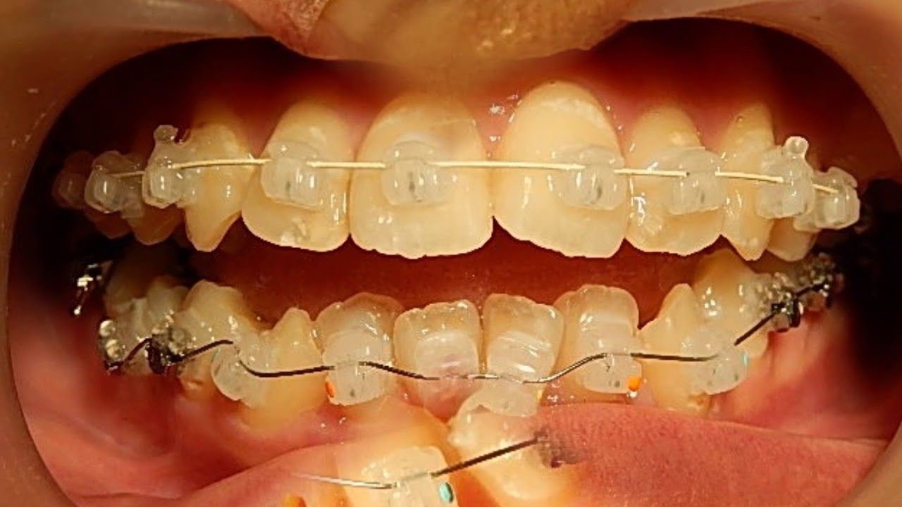 شلوغی دندان یا کراودینگ دندان