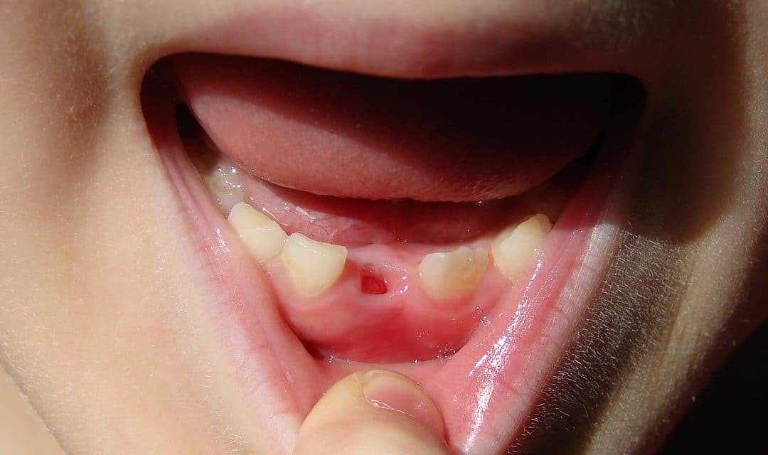 لق شدن دندان در ارتودنسی