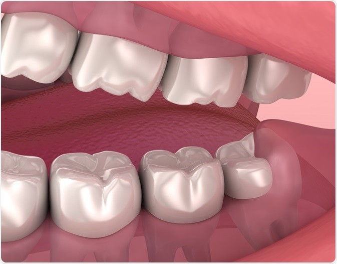 کشیدن دندان عقل در ارتودنسی دندان