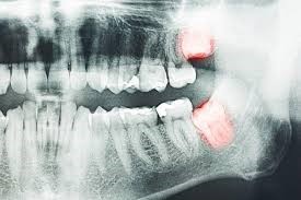 کشیدن دندان عقل در ارتودنسی دندان