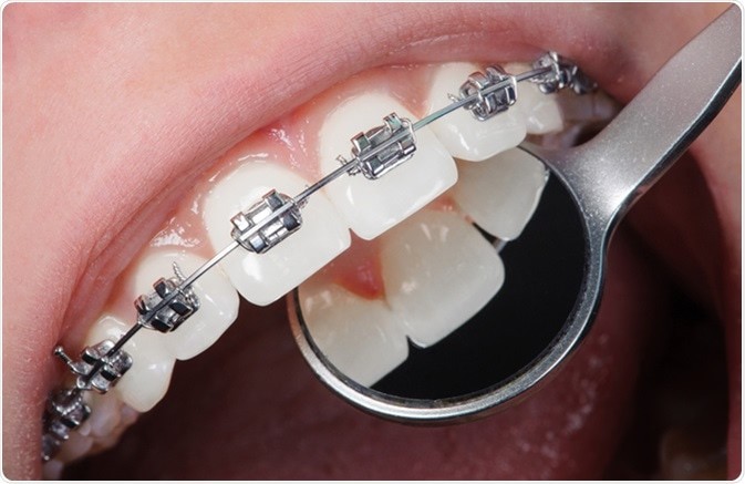 سفید کردن دندان پس از ارتودنسی