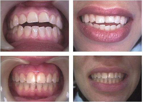 قرینه شدن دندان  بعد از ارتودنسی