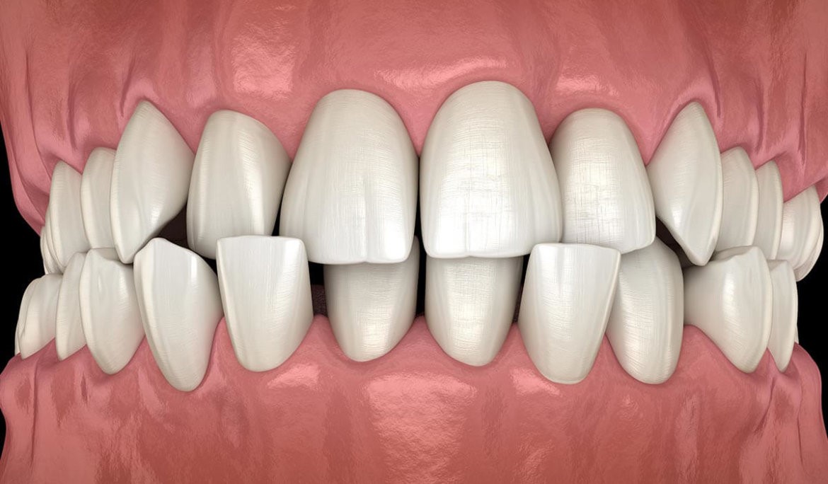 قرینه شدن دندان  بعد از ارتودنسی