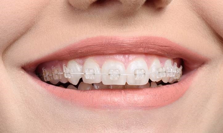 سفید کردن دندان حین درمان ارتودنسی