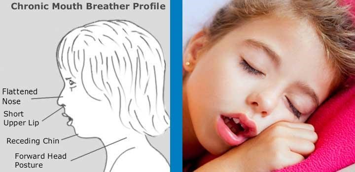 نقش ارتودنسی در بهبود تنفس دهانی