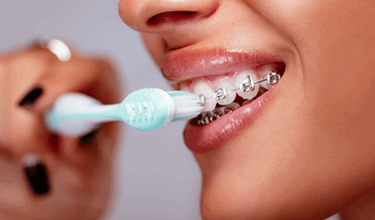 درمان زخم دهان حین ارتودنسی