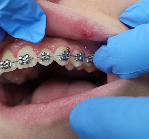 درمان زخم دهان حین ارتودنسی