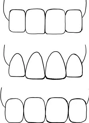 تراش مینای دندانی در ارتودنسی