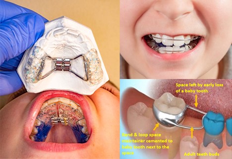 عوارض از دست رفتن زود هنگام دندان شیری