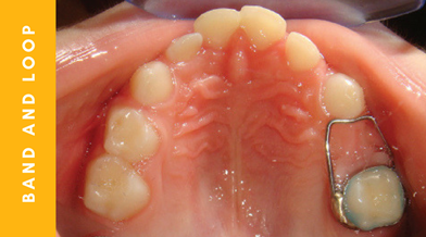 عوارض از دست رفتن زود هنگام دندان شیری