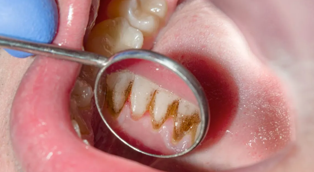 تأثیرات عفونت دندان روی سلامت عمومی