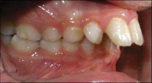 علل جابجایی دندان ها رو به جلو