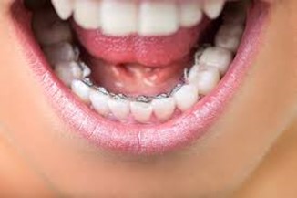 عوارض جانبی احتمالی استفاده از بریس ها