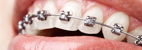 آیا بریس ها می توانند درد مفصل فکی گیجگاهی (TMJ) را برطرف کنند؟