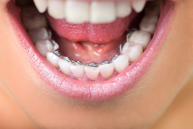 بریس های فک پایین چه تفاوتی با بریس های کامل دارند؟