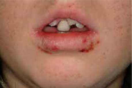 چه چیزی باعث واکنش های آلرژیک به بریس ها می شود؟