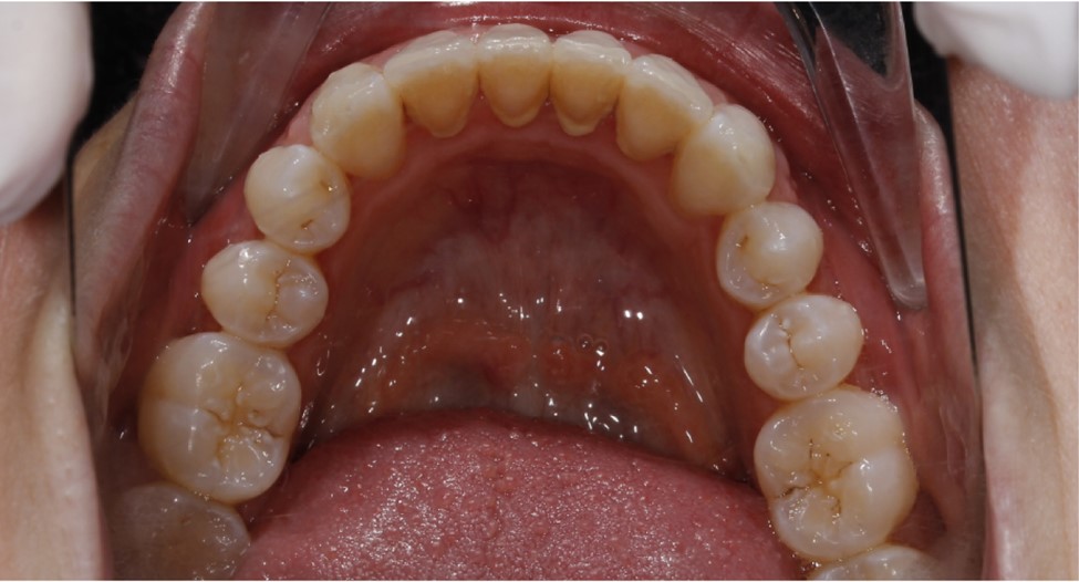 اگر دندان هایم بعد از ارتودنسی حرکت کنند، چه باید بکنم؟