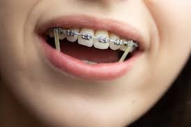 چگونه می توان با استفاده از کش های ارتودنسی، بریس ها را سریع تر جدا کرد؟